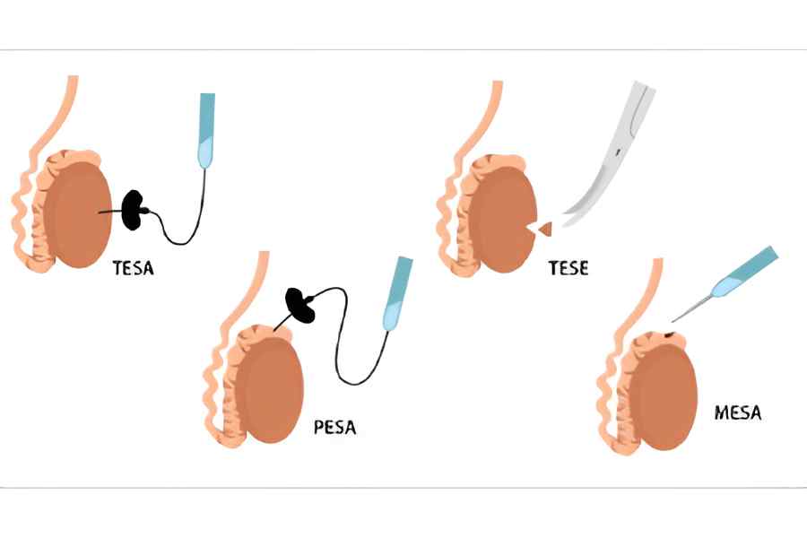 surgical-sperm