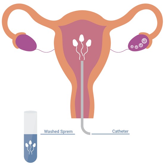 IUI – Intra Uterine Insemination