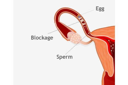 Tubal-Factor-Cause