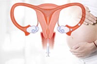IUI – Intra Uterine Insemination